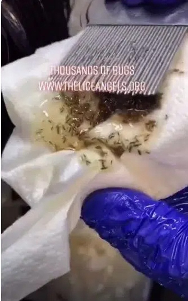 Rùng mình xem cảnh chải đầu của bé gái nhiều chấy chưa từng có, hàng nghìn con chấy lúc nhúc chui ra khỏi tóc chỉ sau 1 lần đưa lược-2