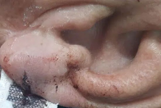 Nguy hiểm: Bố đột quỵ não, con trai lấy dao cứa tai chích máu theo chỉ dẫn trên mạng