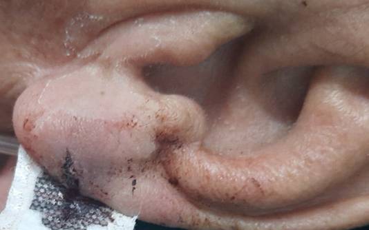 Bố đột quỵ, con dùng dao cứa tai chích máu gây nguy hiểm: BS cảnh báo 3 sai lầm chết người khi xử trí đột quỵ mọi người cần tránh-1