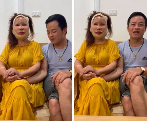 Gương mặt đơ cứng, méo lệch của cô dâu 64 tuổi sau hơn nửa năm dao kéo-1