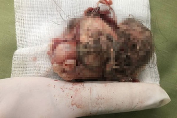 Thủ phạm khiến ổ bụng bé gái chứa đầy răng và tóc-1