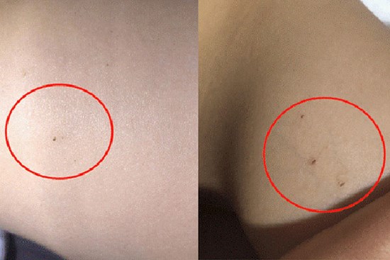 Phát hiện con gái 3 tuổi có gần 30 vết kim đâm trên cơ thể, mẹ điên tiết gọi cô giáo thì nhận được lời giải thích hoang đường