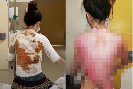 Bực tức vì bị vợ gọi dậy ăn sáng, gã chồng ác quỷ dùng nước sôi tấn công bạn đời cho hả giận, khiến nạn nhân chịu thương tổn đau đớn