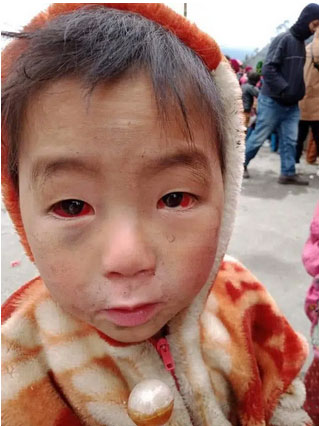 Tấm ảnh cháu bé miền núi phía Bắc bị xuất huyết dưới kết mạc do thời tiết rét lạnh đỏ ngầu cả 2 mắt: BS chuyên khoa Mắt nói sự thật về nguyên nhân-1