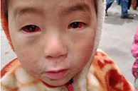 Tấm ảnh cháu bé miền núi phía Bắc 'bị xuất huyết dưới kết mạc' do thời tiết rét lạnh đỏ ngầu cả 2 mắt: BS chuyên khoa Mắt nói sự thật về nguyên nhân