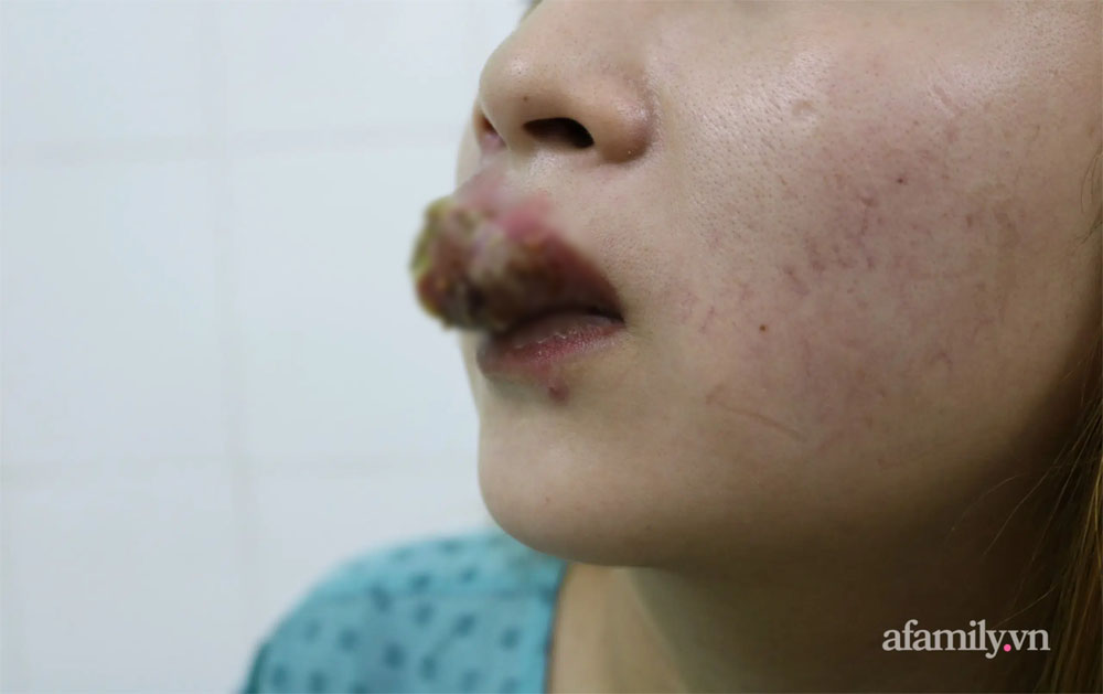 Xăm môi giá 2 triệu đồng đón Tết, cô gái 27 tuổi sưng phù miệng kinh hoàng, chảy mủ nặng nề-1