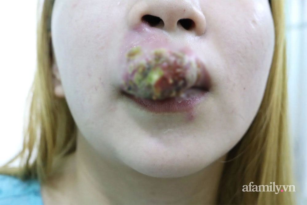 Xăm môi giá 2 triệu đồng đón Tết, cô gái 27 tuổi sưng phù miệng kinh hoàng, chảy mủ nặng nề-2