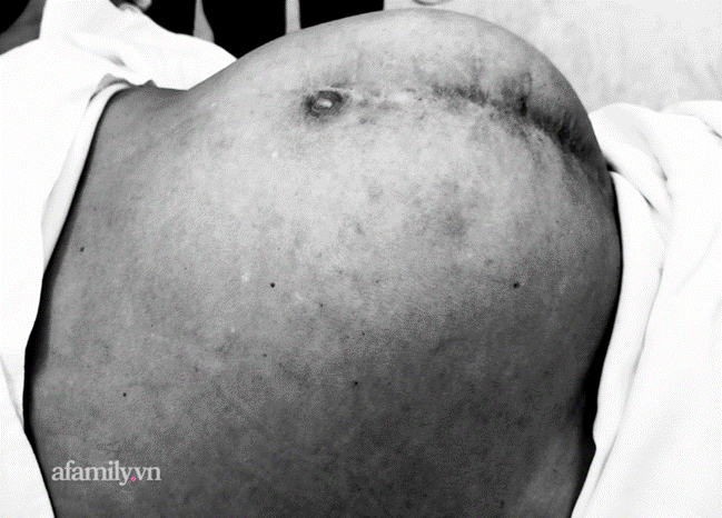 Căng bụng 4 tháng trời nhưng chủ quan, người phụ nữ không ngờ bị ung thư giai đoạn 3-1