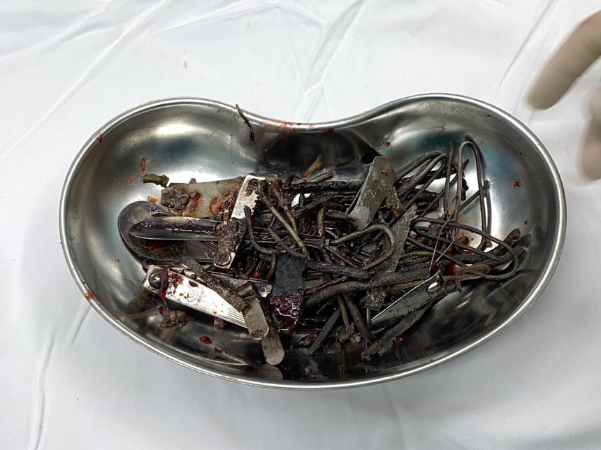 Ăn kim loại, loét da toàn thân và những căn bệnh lạ ở Việt Nam-1