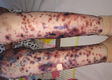 Ăn kim loại, loét da toàn thân và những căn bệnh lạ ở Việt Nam-3