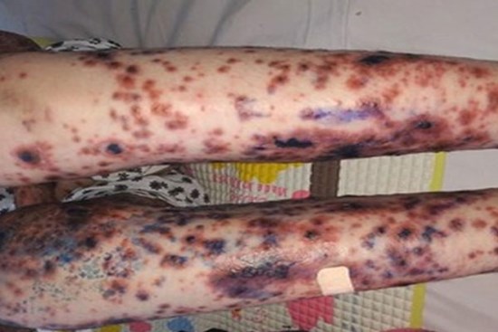 Ăn kim loại, loét da toàn thân và những căn bệnh lạ ở Việt Nam