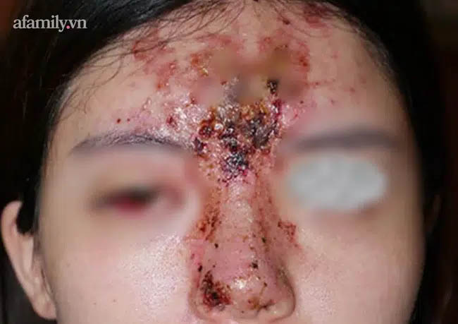 Nâng mũi bằng filler tại một spa ở TP.HCM, cô gái 24 tuổi giảm thị lực, mặt sưng tấy chảy dịch khủng khiếp-2