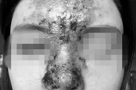 Nâng mũi bằng filler tại một spa ở TP.HCM, cô gái 24 tuổi giảm thị lực, mặt sưng tấy chảy dịch khủng khiếp