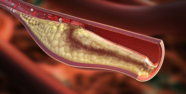 Cholesterol cao là nguyên nhân gây bệnh tim mạch và đột quỵ sớm: Cần nắm 5 cách để xử lý nhanh gọn chỉ trong thời gian ngắn-1