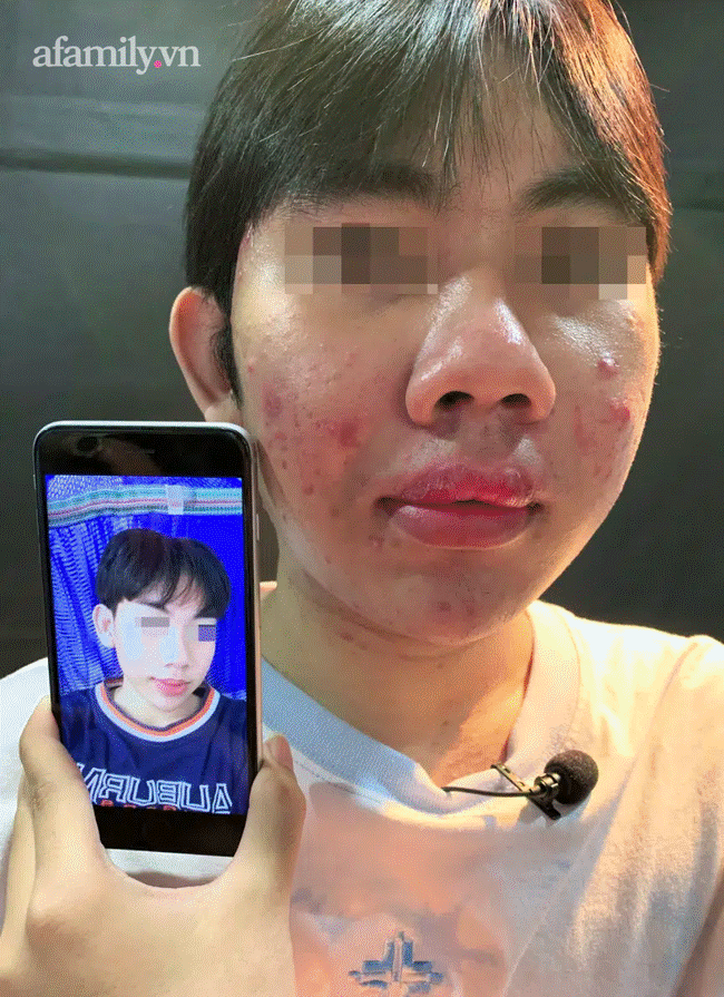 Trà Vinh: Cả xóm rủ nhau mua silicon chợ về tự tiêm gây biến chứng hàng loạt, 1 phụ nữ bơm ngực tử vong-1