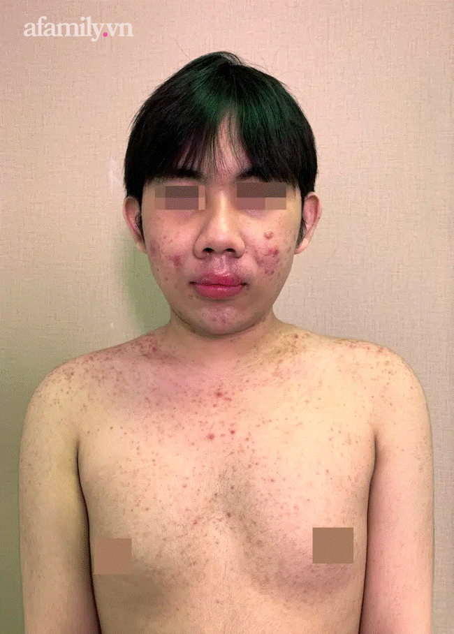 Trà Vinh: Cả xóm rủ nhau mua silicon chợ về tự tiêm gây biến chứng hàng loạt, 1 phụ nữ bơm ngực tử vong-5