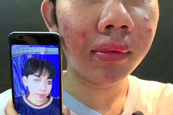 Trà Vinh: Cả xóm rủ nhau mua silicon chợ về tự tiêm gây biến chứng hàng loạt, 1 phụ nữ bơm ngực tử vong