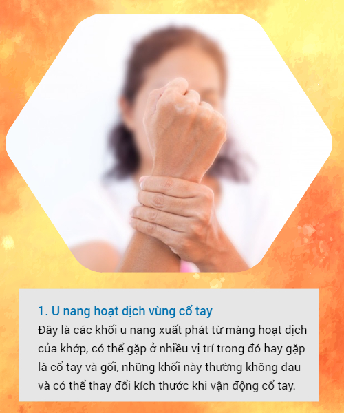 BS khuyến cáo về các loại u vùng cổ tay hay gặp: Đừng bỏ qua vì đó có thể là dấu hiệu cảnh báo bệnh nguy hiểm-1
