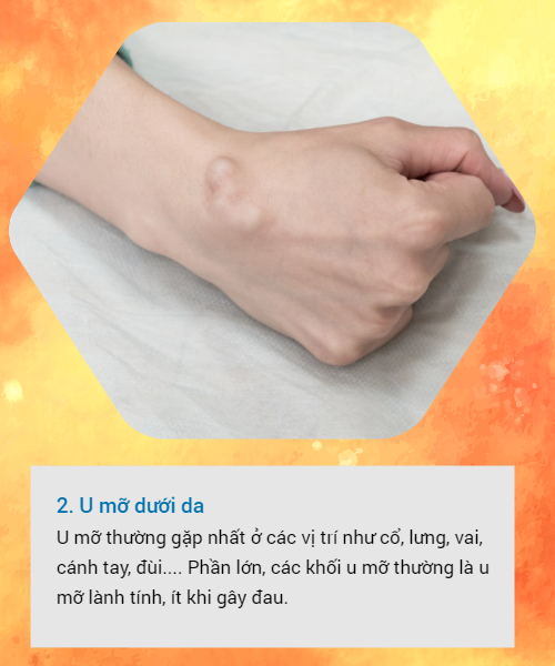 BS khuyến cáo về các loại u vùng cổ tay hay gặp: Đừng bỏ qua vì đó có thể là dấu hiệu cảnh báo bệnh nguy hiểm-2