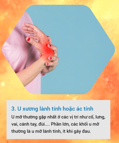 BS khuyến cáo về các loại u vùng cổ tay hay gặp: Đừng bỏ qua vì đó có thể là dấu hiệu cảnh báo bệnh nguy hiểm-3