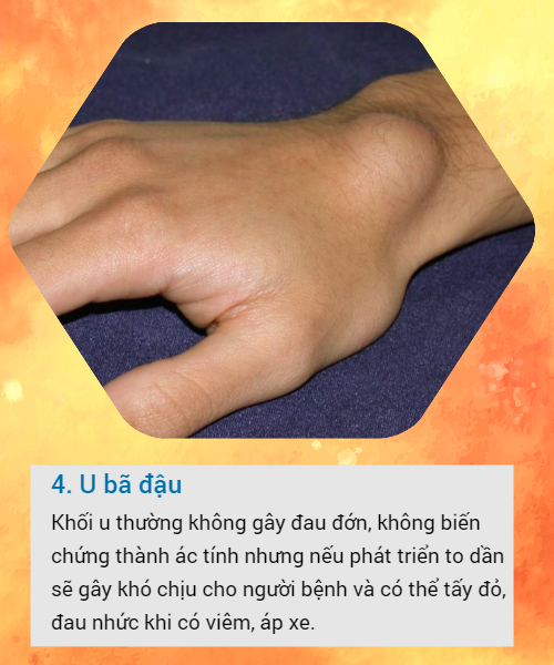 BS khuyến cáo về các loại u vùng cổ tay hay gặp: Đừng bỏ qua vì đó có thể là dấu hiệu cảnh báo bệnh nguy hiểm-4