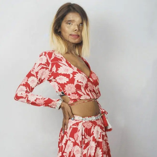 Bé gái 2 tháng tuổi bị cha tạt axit vì không phải là con trai, tưởng không sống được bao lâu nào ngờ 26 năm sau có cuộc đời đáng kinh ngạc-2