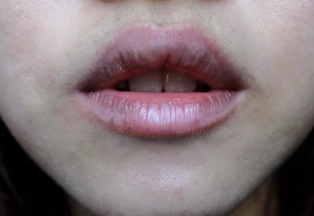 Con gái mắc bệnh phụ khoa thường có 3 triệu chứng nổi quanh miệng, số 2 nhiều người dễ gặp phải-2