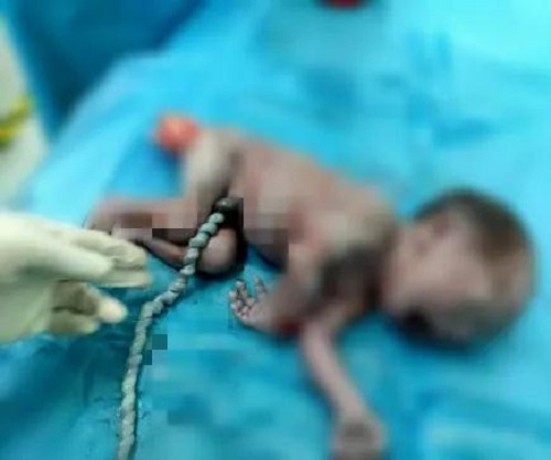 Thai phụ nhập viện mổ gấp vì con ít cử động, sau khi lấy em bé ra mà ekip mổ phải choáng váng-2