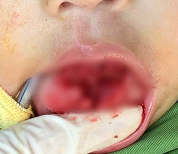 Bé 1 tuổi bị tai nạn rách lưỡi, nguyên nhân trẻ nào cũng dễ gặp phải-1