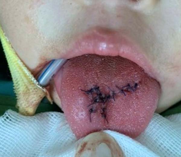 Bé 1 tuổi bị tai nạn rách lưỡi, nguyên nhân trẻ nào cũng dễ gặp phải-2
