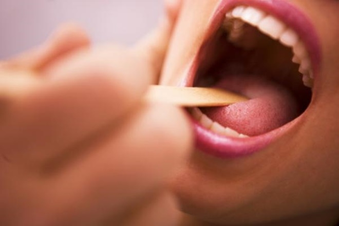 Dấu hiệu ở lưỡi cảnh báo bệnh ung thư-1