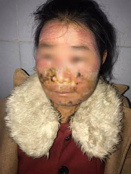 Dùng kem trộn mua trên mạng về bôi, 1 ngày sau cô gái 28 tuổi bị lở loét, chảy dịch, sưng phù mặt-1