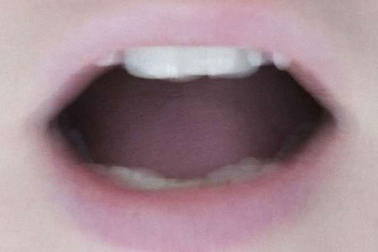 Phát hiện triệu chứng mới có thể là dấu hiệu của Covid-19