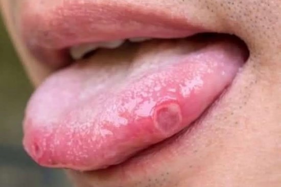 Xuất hiện 3 triệu chứng mới là dấu hiệu ban đầu mắc COVID-19