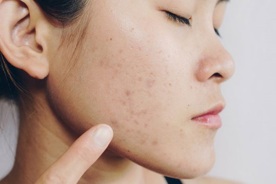 Làn da của bạn sẽ ra sao khi đi ngủ không tẩy trang?