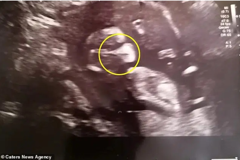 Siêu âm ở tuần 12 thấy hình ảnh thai nhi đeo khẩu trang”, chỉ vài ngày sau bà mẹ nhận được tin dữ-1