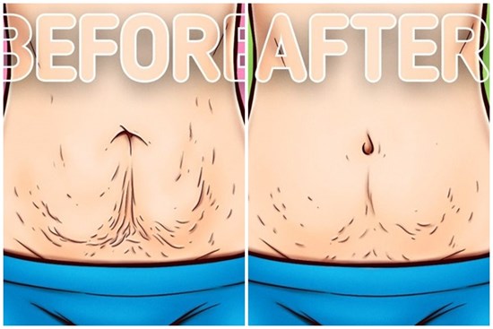 10 mẹo làm săn chắc da sau khi chị em giảm cân hoặc mang thai