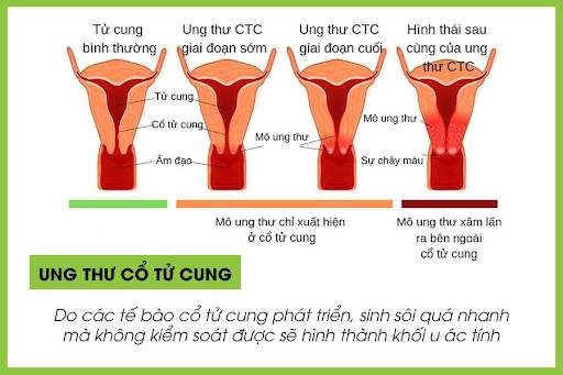 Tượng đài pencak silat Việt Nam Huỳnh Thị Thu Hồng qua đời sau 10 ngày phát hiện ung thư, chị em cần chú ý 3 dấu hiệu của bệnh này ở vùng kín-3