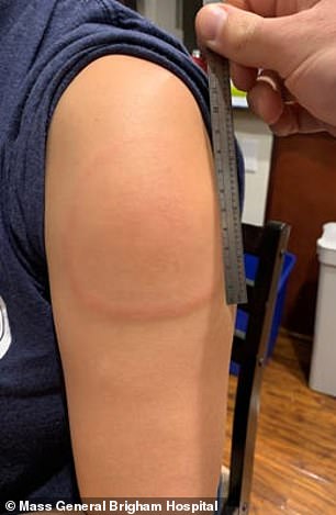 Cánh tay COVID - tác dụng phụ hiếm gặp sau tiêm vaccine COVID-19 mới được báo cáo-1