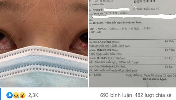 Đeo kính áp tròng làm đẹp dịp Tết, cô gái trẻ ngậm trái đắng khi phải đến viện điều trị viêm giác mạc-2