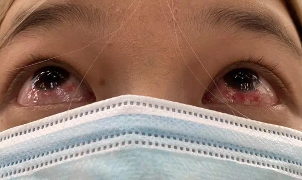 Đeo kính áp tròng làm đẹp dịp Tết, cô gái trẻ ngậm trái đắng khi phải đến viện điều trị viêm giác mạc-3