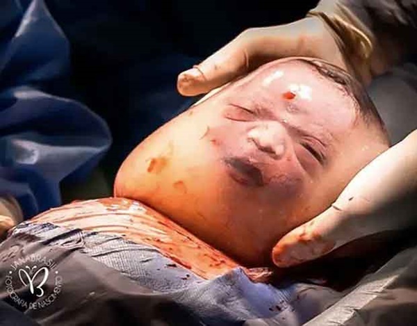 Bé trai trong bức ảnh sinh ra vẫn đang nằm nguyên trong túi ối” từng gây chấn động thế giới vài năm trước giờ ra sao?-2