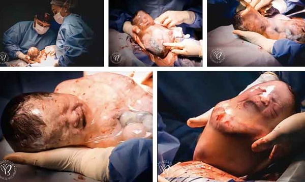 Bé trai trong bức ảnh sinh ra vẫn đang nằm nguyên trong túi ối” từng gây chấn động thế giới vài năm trước giờ ra sao?-4