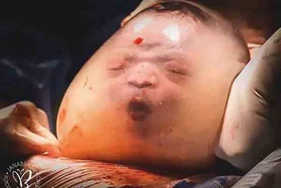 Bé trai trong bức ảnh “sinh ra vẫn đang nằm nguyên trong túi ối” từng gây chấn động thế giới vài năm trước giờ ra sao?