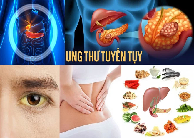 NSND Hoàng Dũng qua đời vì ung thư tụy: Làm sao để sớm ngăn ngừa căn bệnh nguy hiểm này?-2