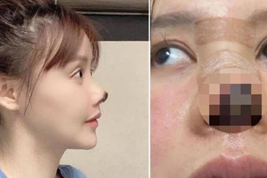 Nữ diễn viên Trung Quốc phẫu thuật thẩm mỹ tới nỗi rụng cả mũi, ngượng không dám thò mặt ra đường