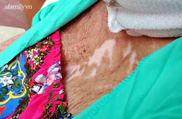 Người phụ nữ trẻ bị chồng tẩm xăng đốt, trải qua 18 ca mổ đau đớn như chết đi sống lại và sự tái sinh nhờ tình mẫu tử thiêng liêng-5