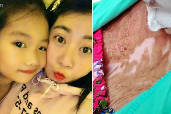 Người phụ nữ trẻ bị chồng tẩm xăng đốt, trải qua 18 ca mổ đau đớn như