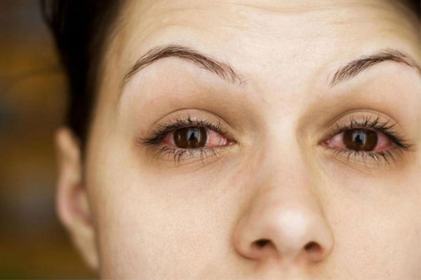 Phát hiện biến chứng nguy hiểm trên mắt ở bệnh nhân Covid-19-1