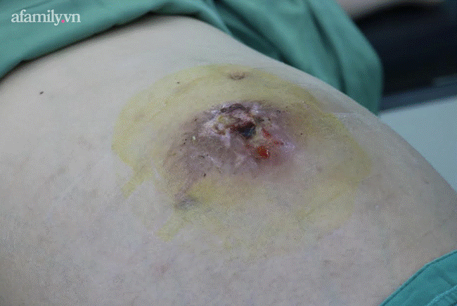 Người phụ nữ lở loét nặng nề, biến chứng nguy kịch vì nghe lời thầy lang dùng kim chích vào khối u xơ tử cung-1